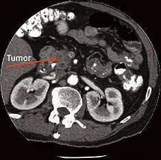 Image of pancreatic cancer tumor during a CT procedure