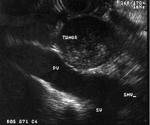 pancreas ultrasound