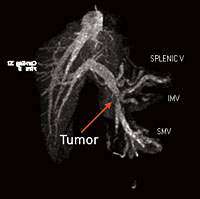 Image of pancreatic cancer tumor during an MRCP procedure