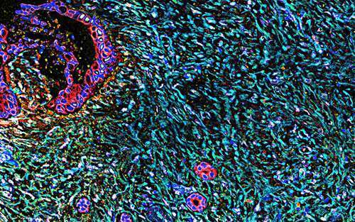 Pancreatic cancer cells