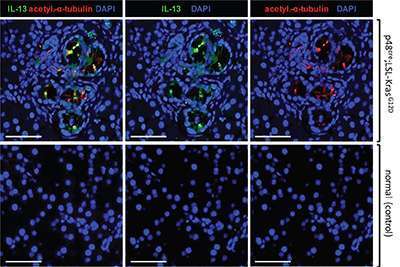 IL-13 in pancreatic tumors in mice