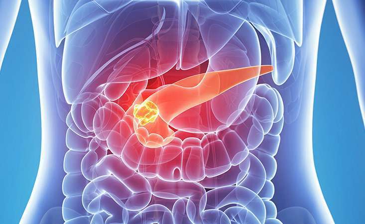 learn-about-pancreatic-neuroendocrine-tumors-nets