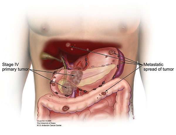 Stage 4 pancreatic cancer, showing the primary tumor in the pancreas and metastasis (spread) throughout body.