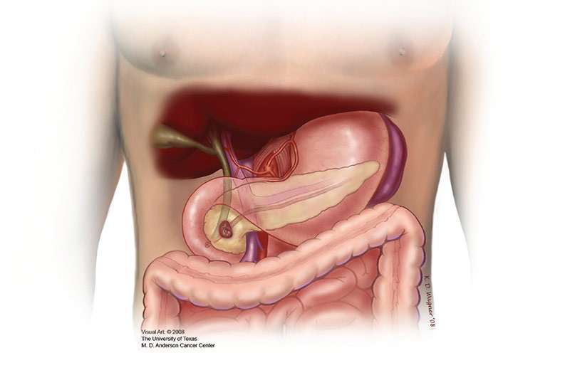 La ilustración de la zona abdominal muestra la cabeza del páncreas con un tumor antes de la cirugía de Whipple.