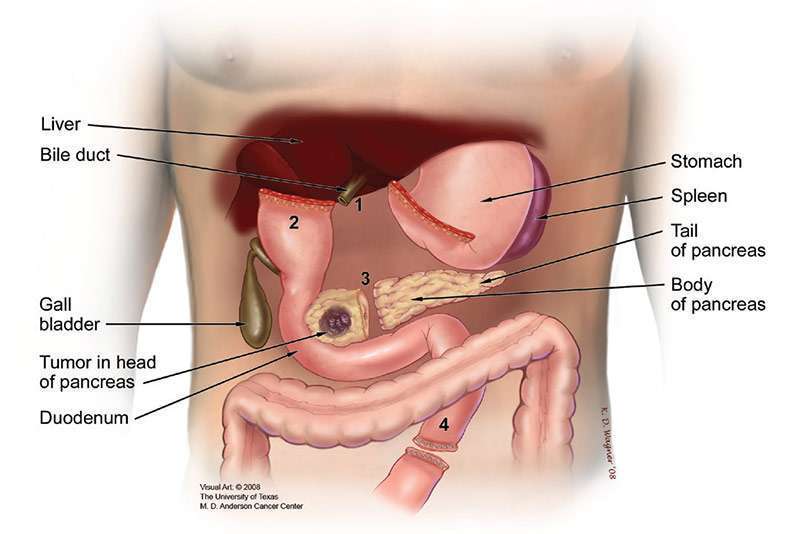 Illustração da área abdominal mostra a separação do ducto biliar, estômago, cabeça do pâncreas e intestino delgado durante a cirurgia de Whipple.