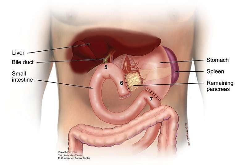 Illustration de la zone abdominale montre la reconnexion du canal biliaire à l'intestin grêle, du pancréas restant à l'intestin grêle et de l'estomac à l'intestin grêle après la chirurgie de Whipple. class=