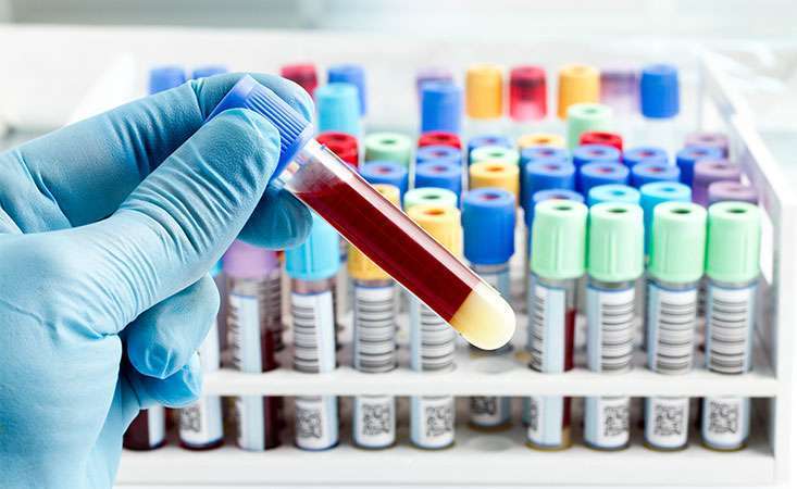 6 Things to Know about Cancer Blood Tests - Pancreatic Cancer