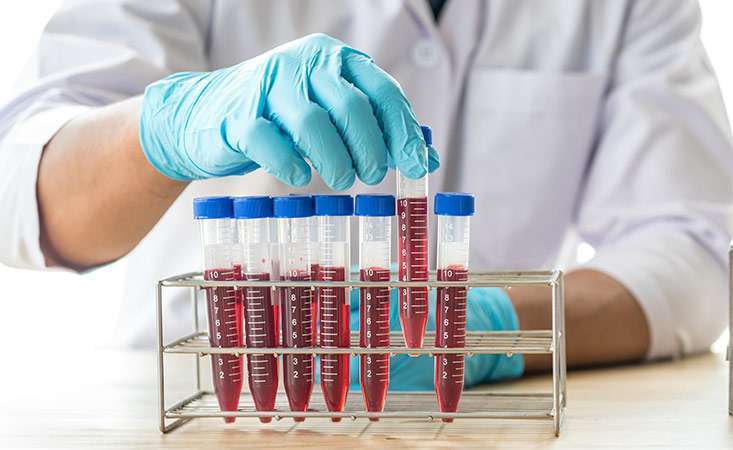 Researcher examines a blood sample for potential pancreatic cancer biomarkers