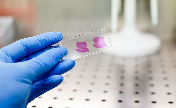 A tissue sample from a pancreatic tumor provides information to guide treatment decisions