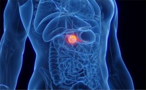 The Latest Developments in Early Detection for Pancreatic Cancer -  Pancreatic Cancer Action Network