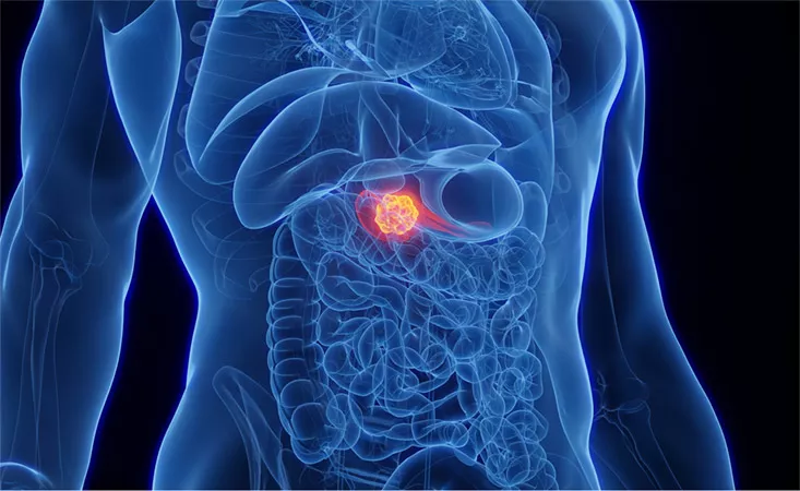 pancreatic cancer illustration